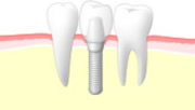 インプラント