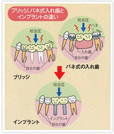 部分入れ歯の方へ