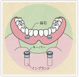 入れ歯とマグネットデンチャーの比較