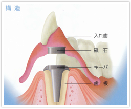 磁石式入れ歯