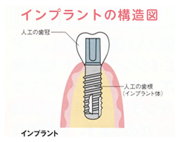 インプラントとは？